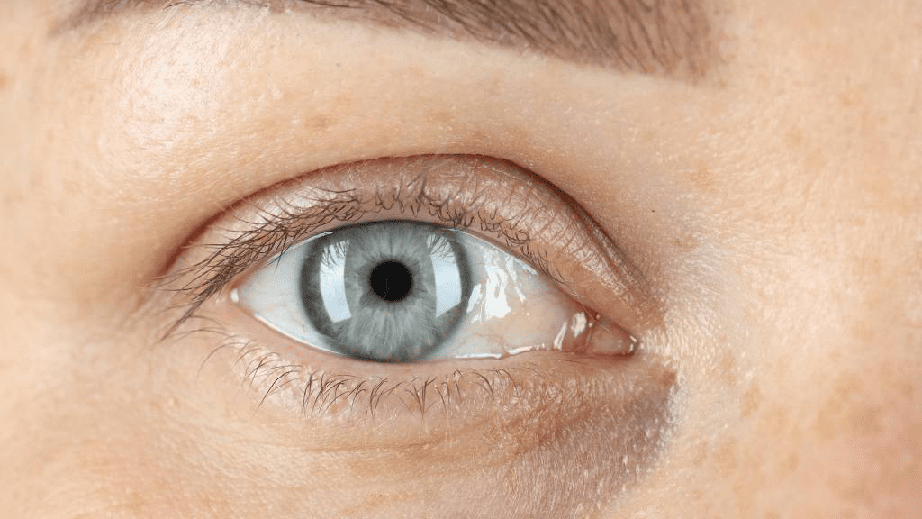 Nahaufnahme einer Augenpartie. Zu sehen ist das Schlupflid sowie blaue Augen.