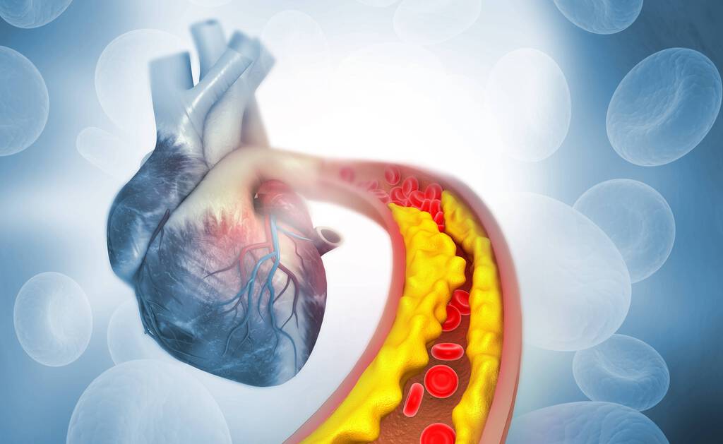 Eine 3D-Illustration eines menschlichen Herzens mit einer Cholesterin Plaque in einer Koronararterie.