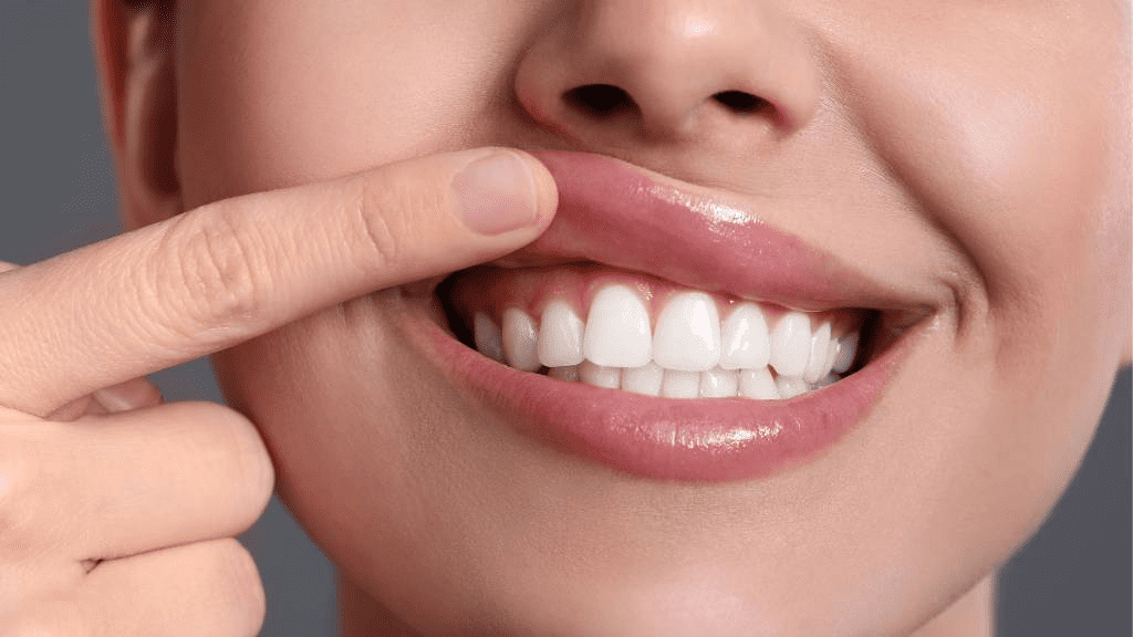 Eine Person präsentiert ihr strahlend weißes Lächeln. Dafür zieht sie mit einem Finger ihre Oberlippe seitlich leicht nach oben.