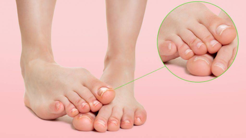 Ein nackter Fuß steht auf dem anderen. Die Nägel haben geröttete und braune Stellen vom Nagelpilz. Rechts die Zehen in in einem runden Ausschnitt vergrößert.