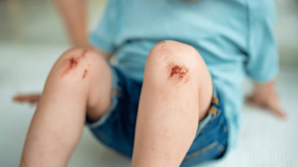 Kind mit Schürfwunden an beiden Knien nach einem Sturz, sichtbare oberflächliche Hautverletzungen mit Krustenbildung – typisches Beispiel für akute Wunden, die eine sorgfältige Reinigung und kindgerechte Wundversorgung erfordern.
