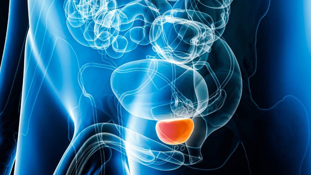 Medizinische Illustration des männlichen Beckens mit hervorgehobener Prostata unterhalb der Blase – Darstellung einer Prostatavergrößerung (BPH) und möglicher Ursache von Harnwegsbeschwerden.