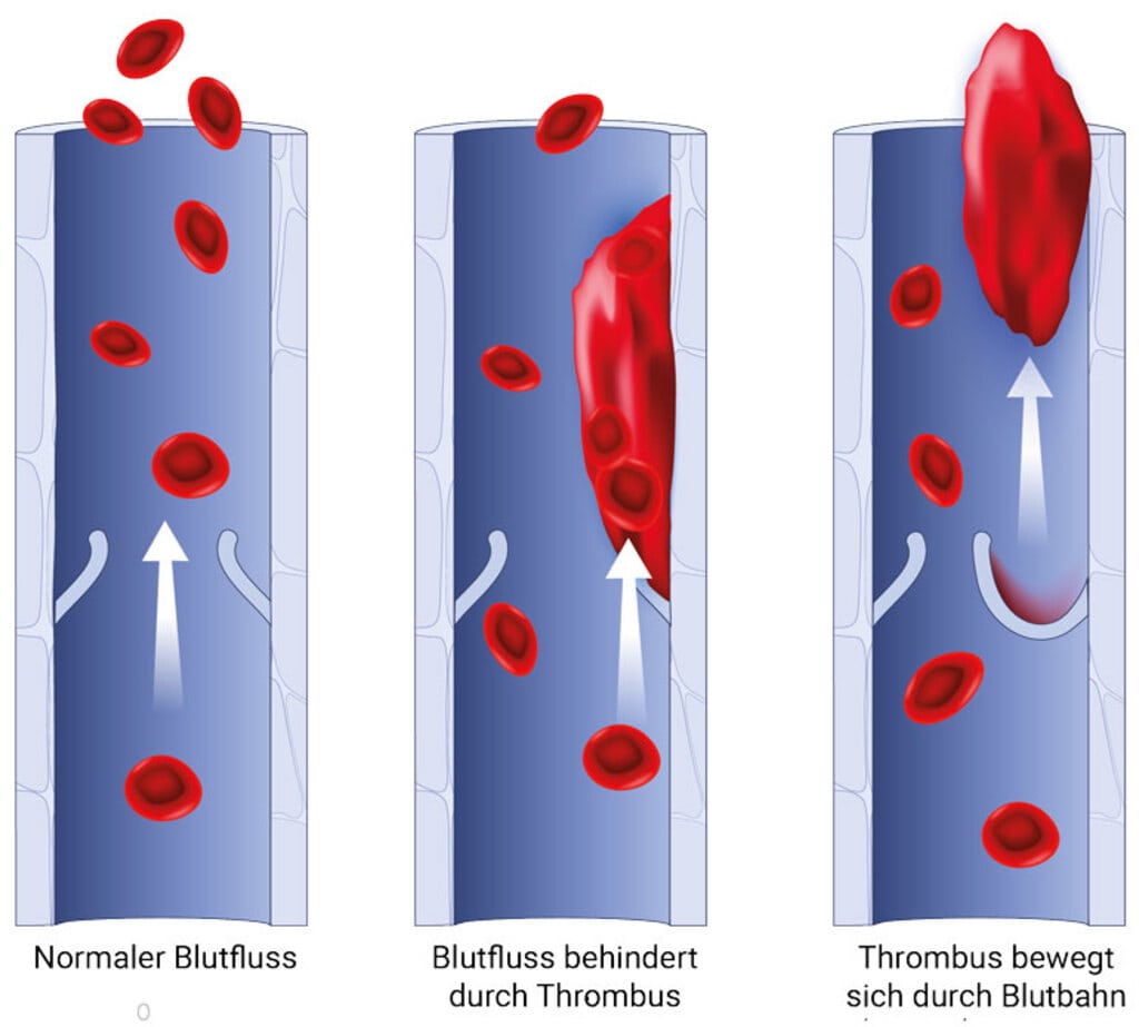 Vereinfachte Darstellung eines normalen Blutflusses, eines durch einen Thrombus gestörten Blutflusses und eines Thrombus in der Blutbahn, der sich gelöst hat und eine Lungenembolie auslösen kann