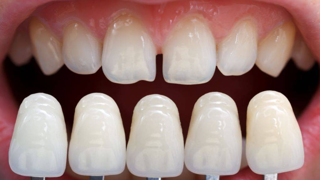 Nahaufnahme eines Zahnvergleichs mit Veneers vor dem natürlichen Gebiss