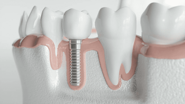 Schritt für Schritt zum festen Zahn: So läuft eine Implantatbehandlung ab
